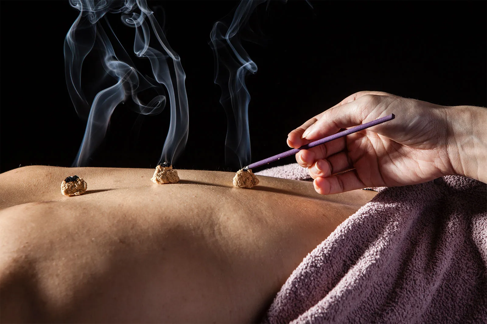 moxibustion-cones-moxa-treatment-points-top-needles